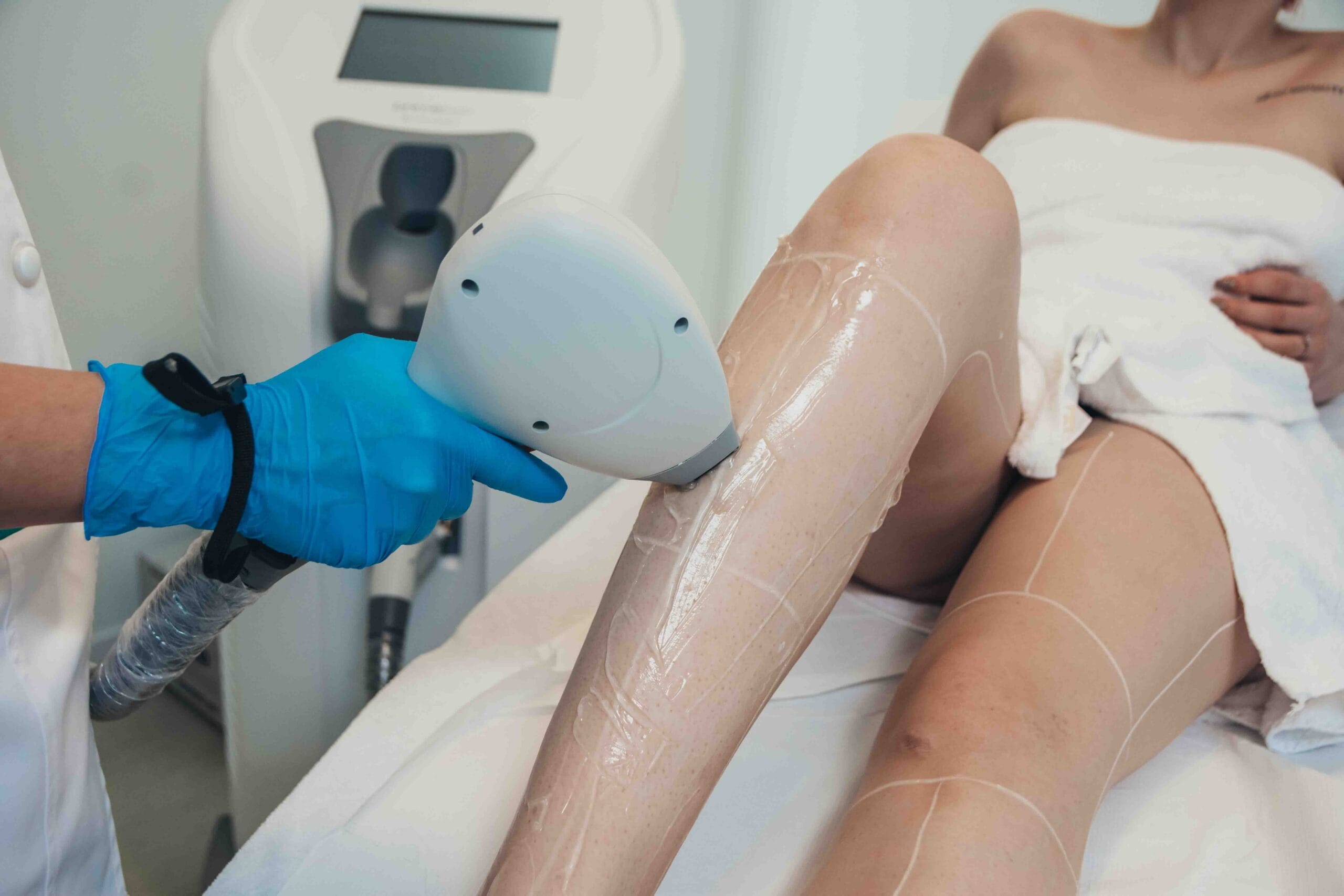 Sedinta de epilare definitiva cu laser cu Primelase HR Excellence la Episculpt Beauty Sibiu