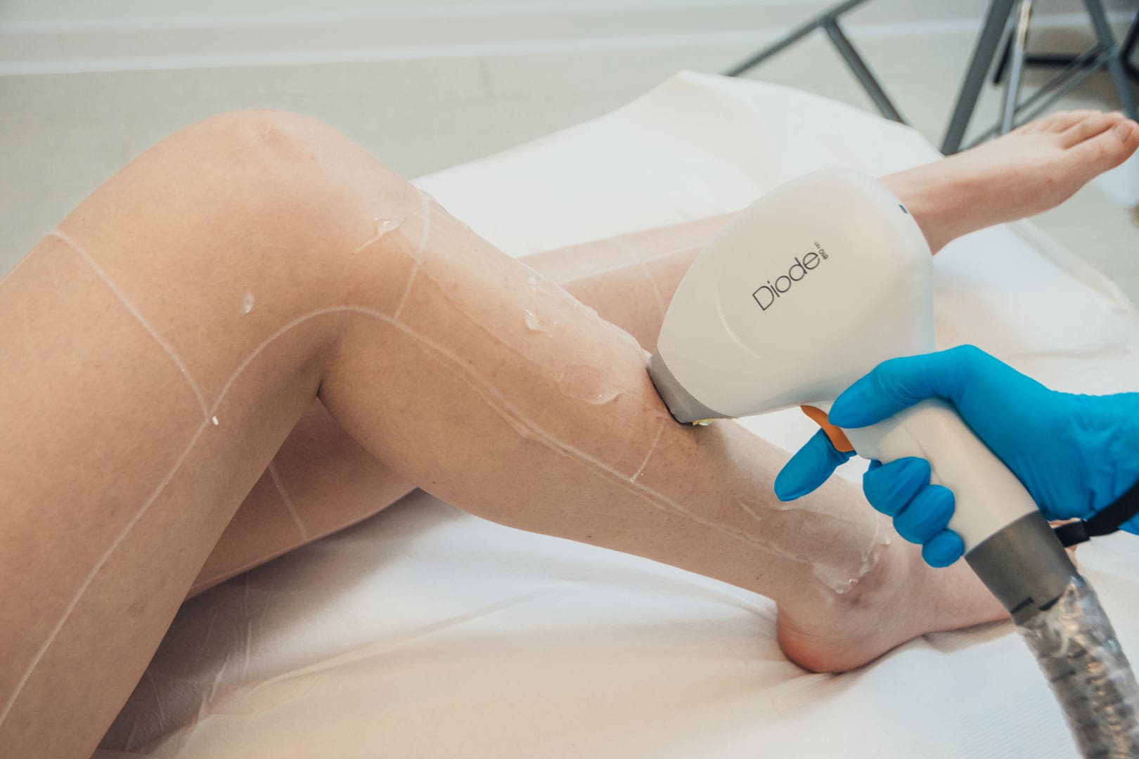 Epilare laser solutia ideala pentru hirsutism si hipertricoza