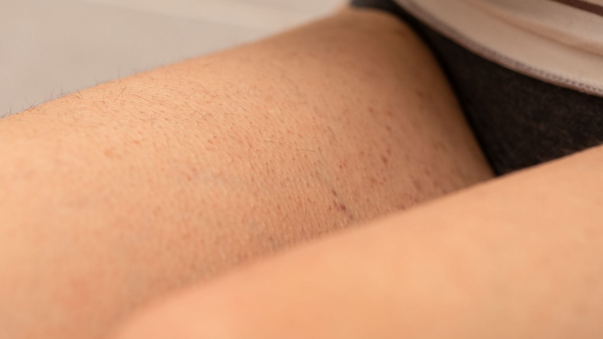 Epilarea definitiva cu laser solutia ideala pentru tratarea foliculitei o gasesti acum la Episculpt Beauty Sibiu