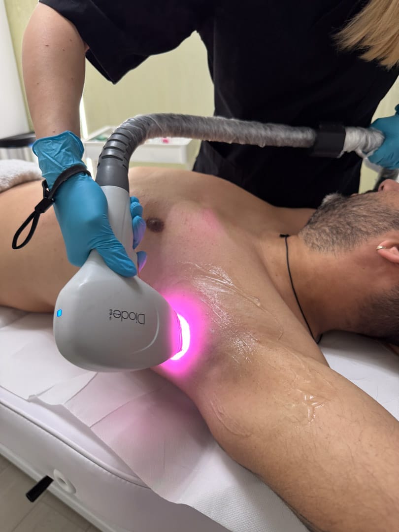 sedinta de epilare definitiva cu laser dioda pentru barbati zona axilelor