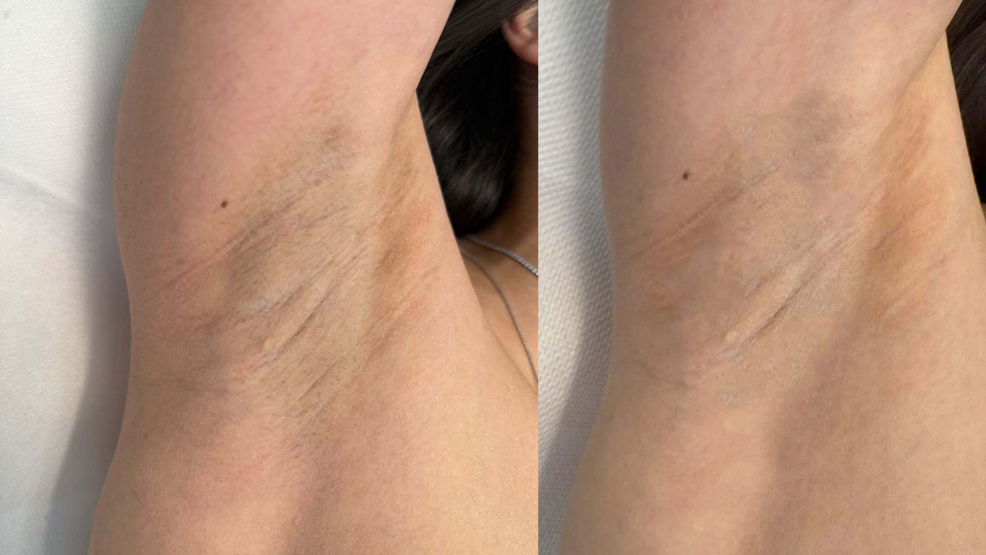 rezultat before and after dupa 2 tratamente de epilare definitiva cu laser la episculpt beauty