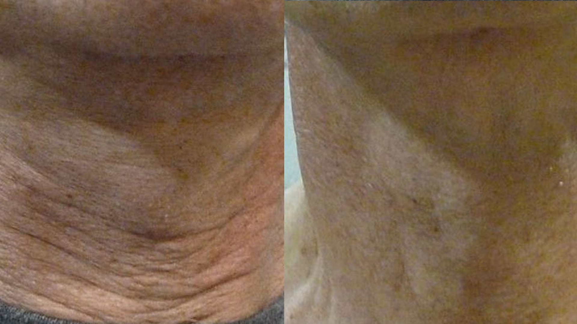 rezultat before and after dupa lifting facial prin radiofrecventa bipolara la episculpt beauty sibiu