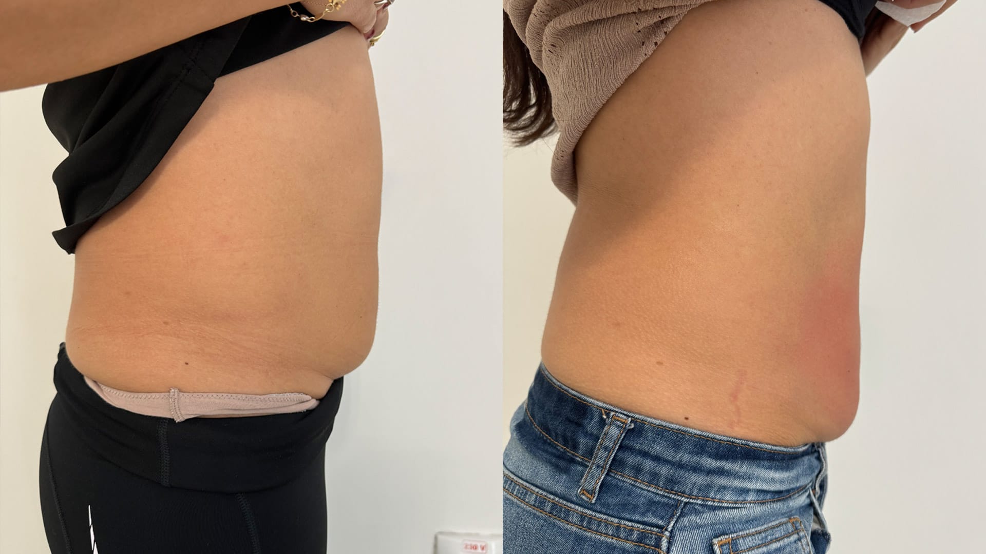 rezultat before and after dupa 1 sedinte de remodelare corporala prin radiofrecventa la episculpt beauty sibiu