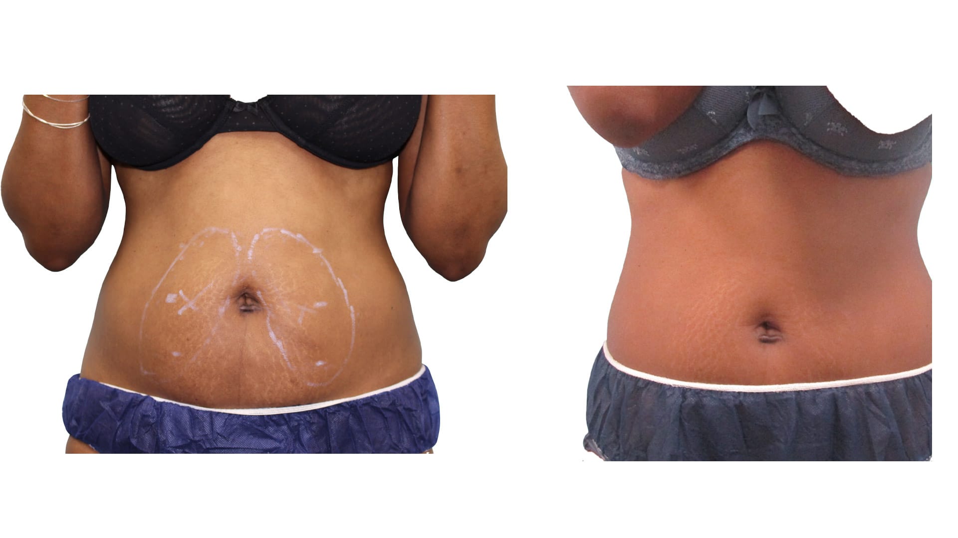 rezultat dupa aplicarea criolipolizei cooltech pe abdomen la episculpt beauty sibiu