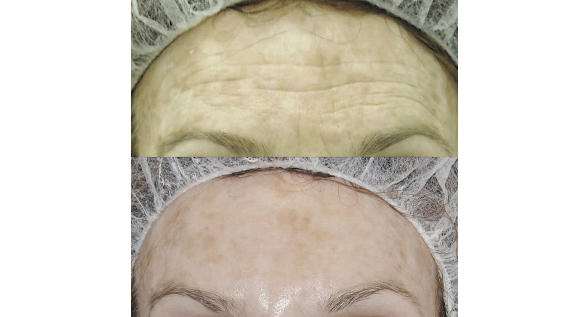 rezultat before and after dupa tratamentul de lifting facial prin radiofrecventa bipolara la episculpt beauty sibiu