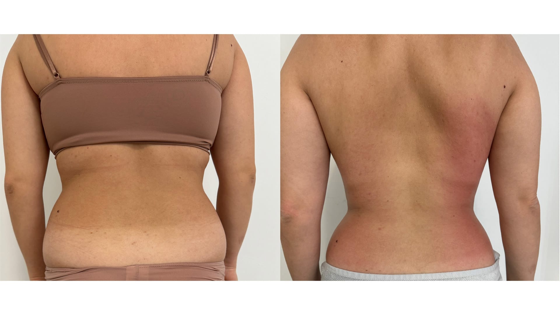 rezultat before and after dupa 3 sedinte de remodelare corporala prin radiofrecventa asupra flancurilor la episculpt beauty sibiu