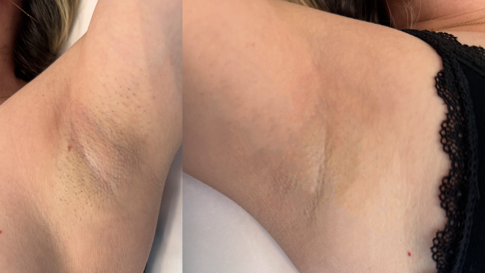 rezultat before and after dupa 2 sedinte de epilare definitiva a axilelor