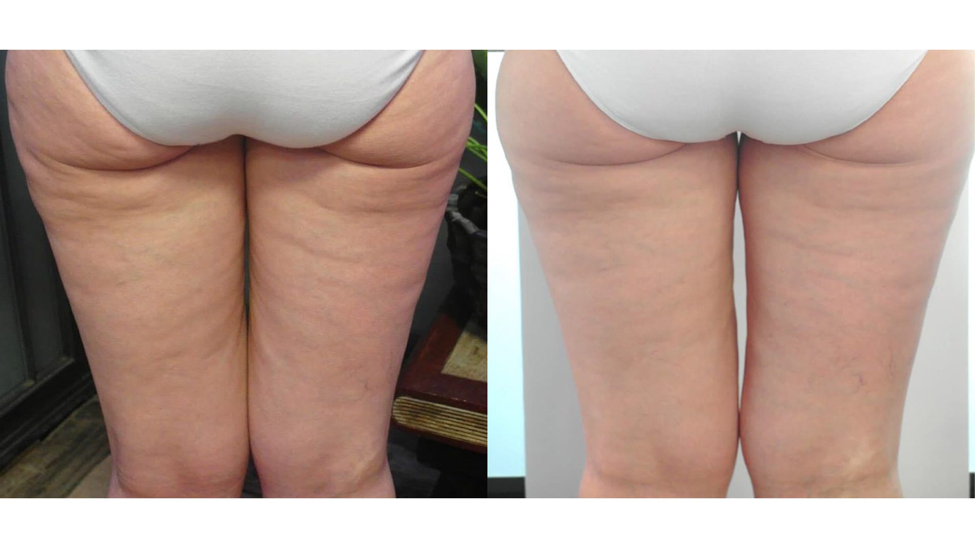 rezultat before and after dupa tratamentul nostru anticelulitic prin radiofrecventa multipolara cu viora v10 v-form